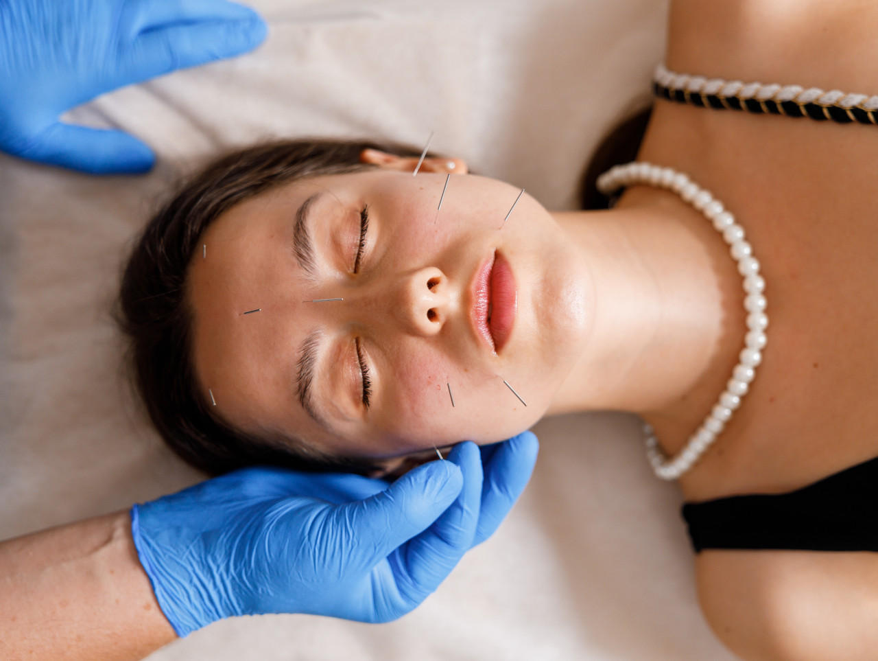 Акупунктурний ліфтинг обличчя у Івано-Франківську, рефлексотерапія, голковколювання